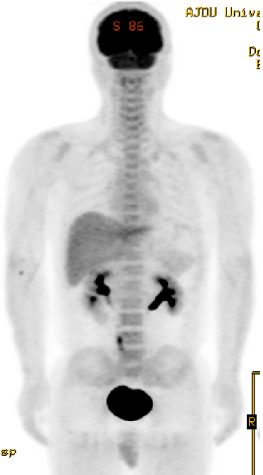 전신암검사(PET CT)