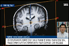 뇌지도가 치매 등 난치병 치료에 어떤 도움을 주는가 - 신경과 임태성 교수